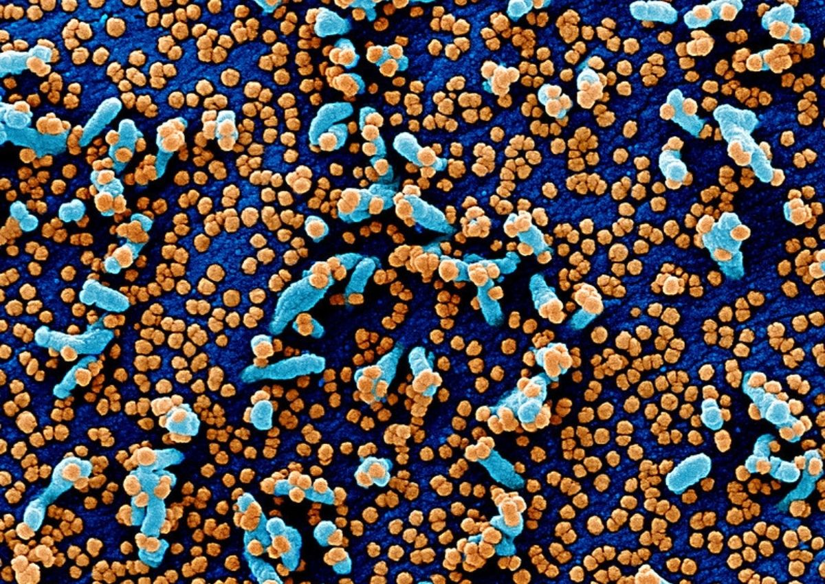 VERO E6 cell infected with COVID-19 virus particles