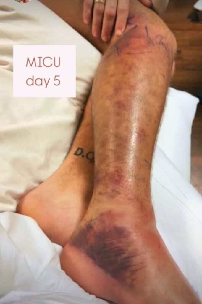 David Humphlett's leg after being bitten by an eastern diamondback rattlesnake on Dec. 18.