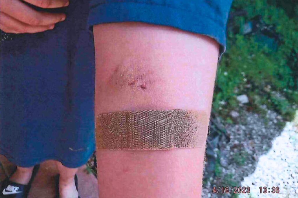 A photo the arm of Mia, Kathleen Leto's daughter, who was bit by one of the family's pit bull-type dogs. Courtesy of Miami-Dade County Animal Services Department